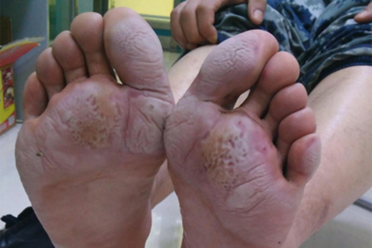 浸渍擦烂性皮炎皮肤出现小孔图 浸渍擦烂性皮炎皮肤出现小孔图