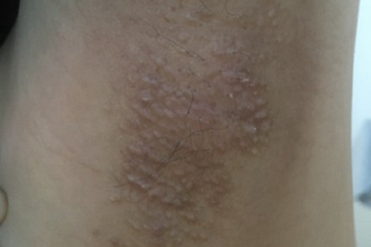 福克斯-福代斯病小疙瘩图