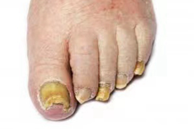 黄甲综合征脚趾甲症状图