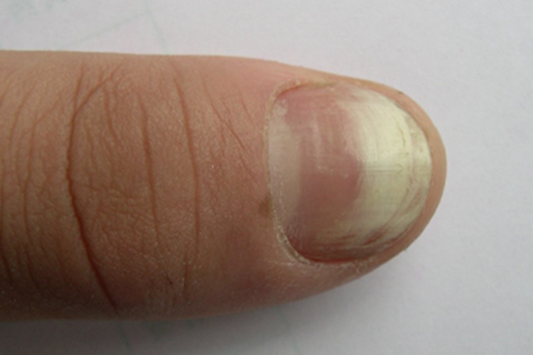银屑病甲指甲白斑图
