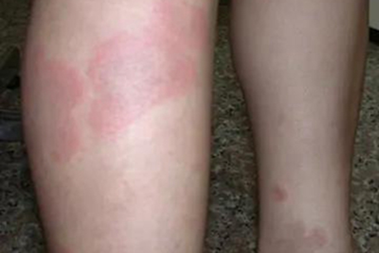 蛋白胨性荨麻疹小腿症状图 蛋白胨性荨麻疹小腿症状图