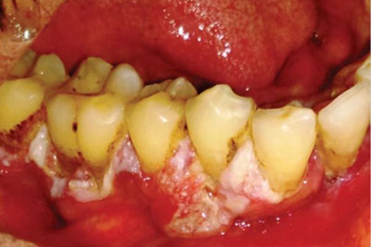 牙龈癌牙龈出现溃疡图