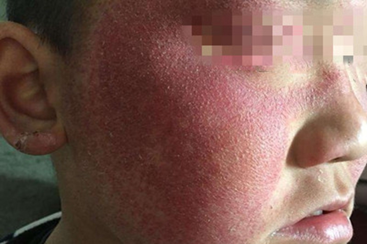 原卟啉病症状图 原卟啉病症状图