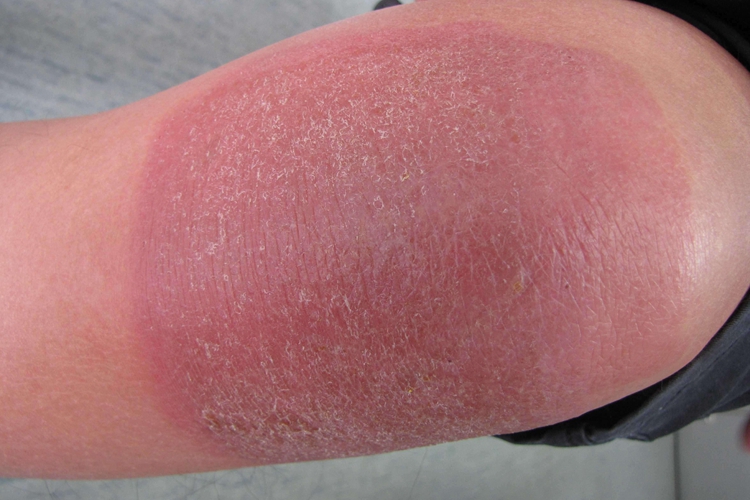 宝宝腿部急性接触性皮炎图