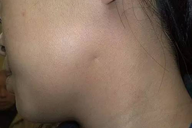 鳃裂囊肿侧颈症状图 鳃裂囊肿侧颈症状图