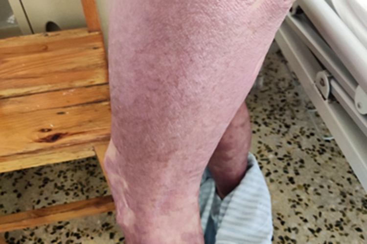 青年成人期特应性皮炎紫斑图