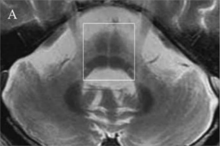 多系统萎缩十字征图 多系统萎缩十字征图
