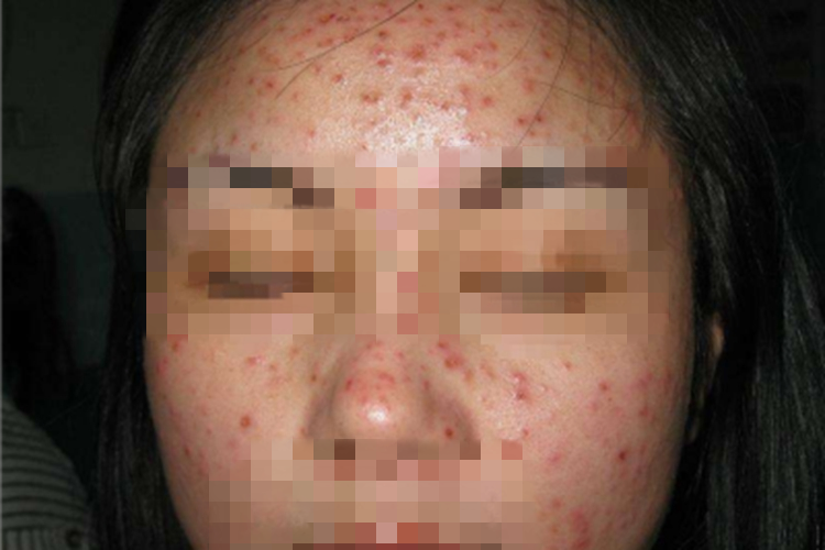 马拉色菌毛囊炎鼻部小红疙瘩图 马拉色菌毛囊炎鼻部小红疙瘩图