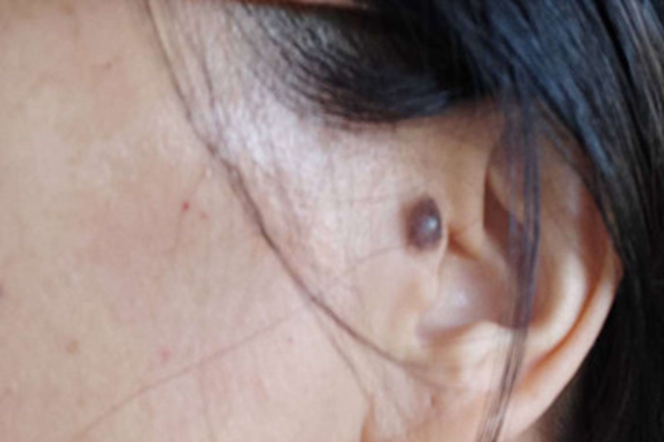 皮内痣耳前症状图