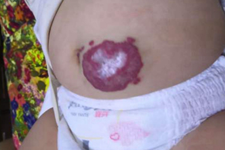 小儿血管瘤上腹症状图