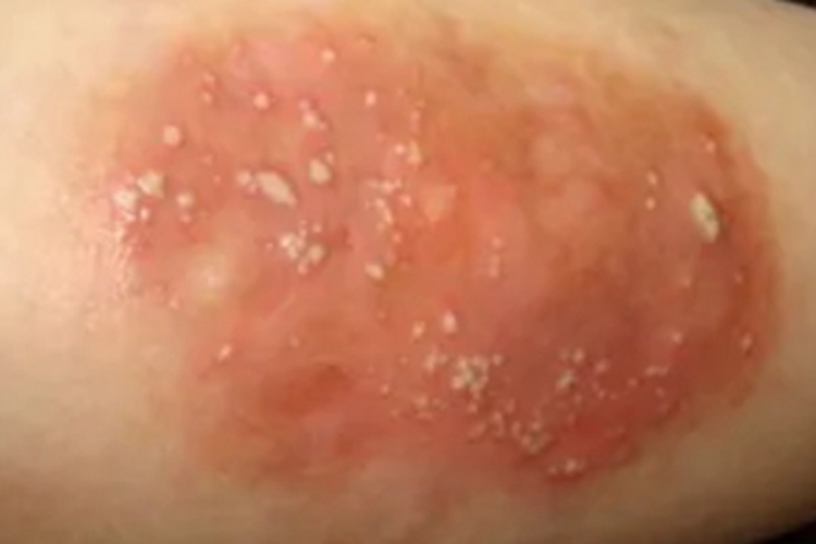 湿疹大腿症状图 湿疹大腿症状图