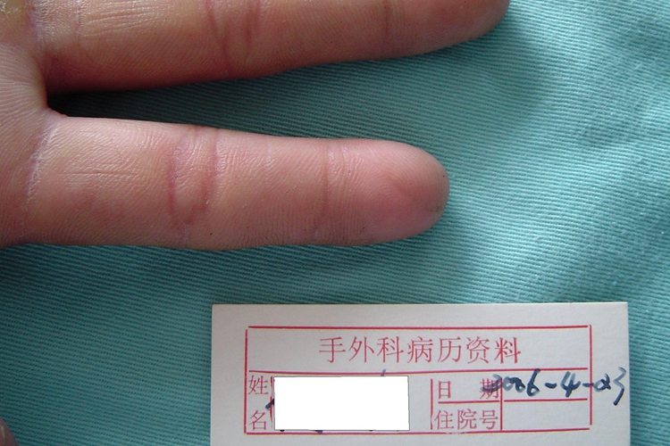 右手食指缺损恢复图 右手食指缺损恢复图