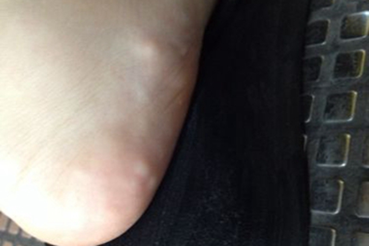 足跟压力性疼痛性丘疹长小疙瘩图 足跟压力性疼痛性丘疹长小疙瘩图