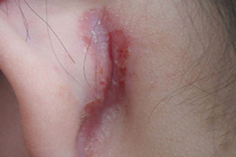 皮肤过敏红肿耳后糜烂图 皮肤过敏红肿耳后糜烂图