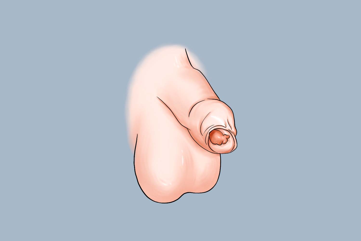 两岁宝宝包皮正常图 两岁宝宝包皮正常图