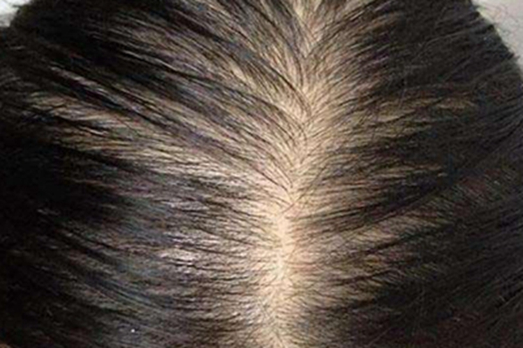 甲状腺功能减退症头发稀疏图