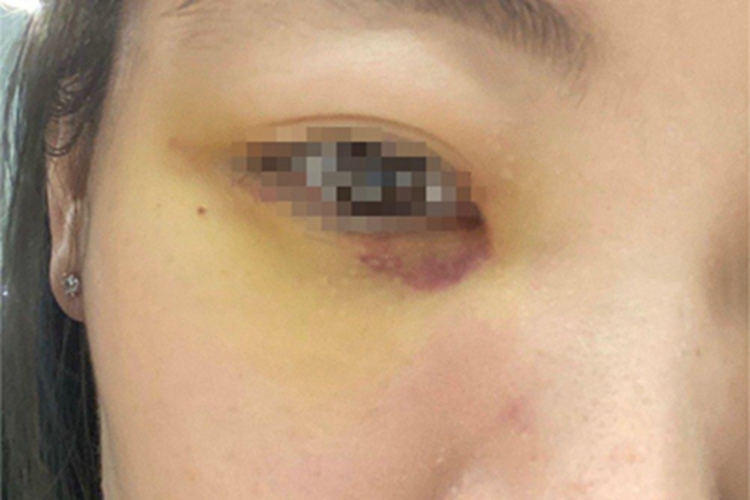 挫伤眼周症状图