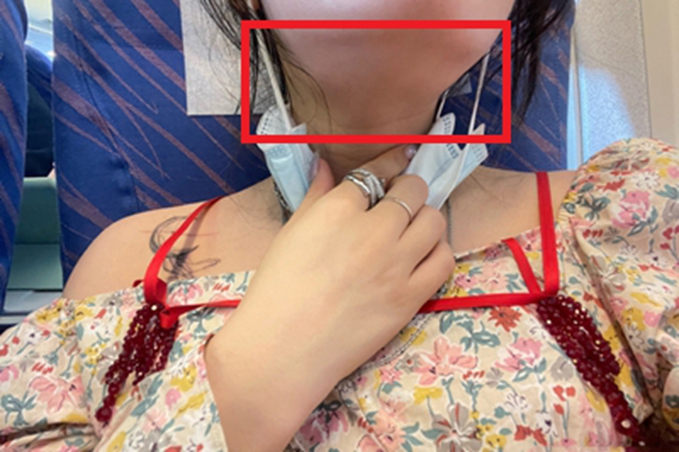 颌下腺炎肿块图