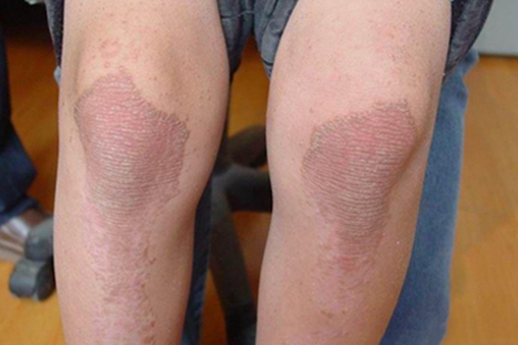 毛发红糠疹性红皮病膝盖症状图