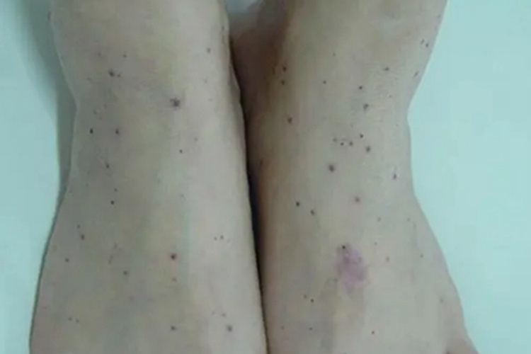 血小板减少性紫癜脚背红点图