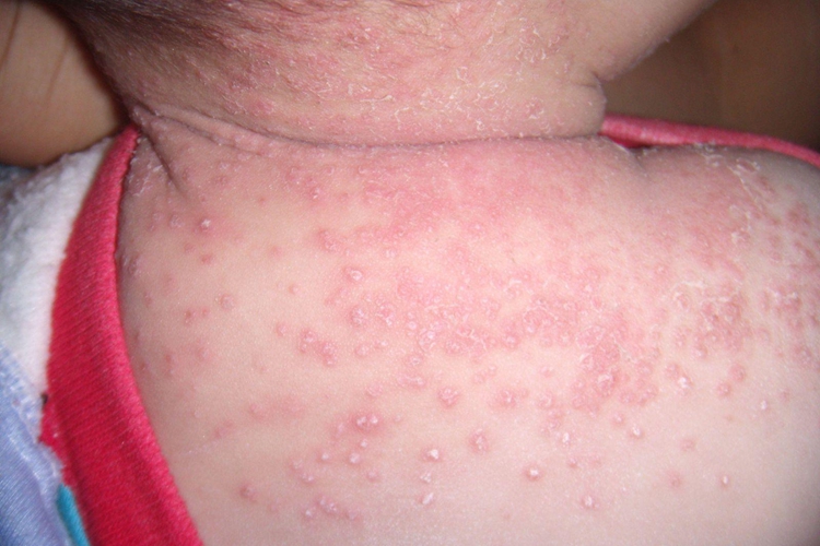 丘疹性荨麻疹与湿疹区别图片