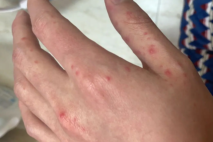 成人手足口手部症状图 成人手足口手部症状图