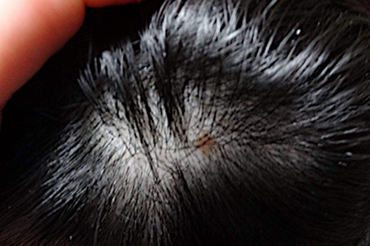 黑色毛结节菌病症状图