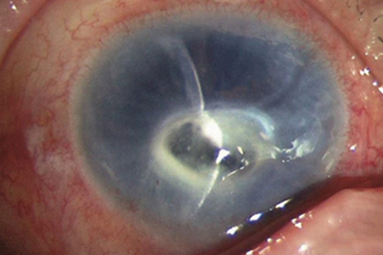 角膜溃疡症状图 角膜溃疡症状图