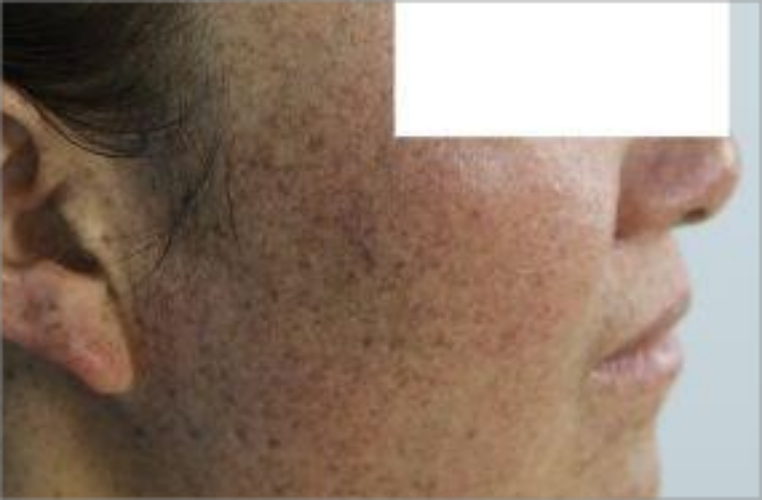 面颈部毛囊红斑黑变病黑斑图