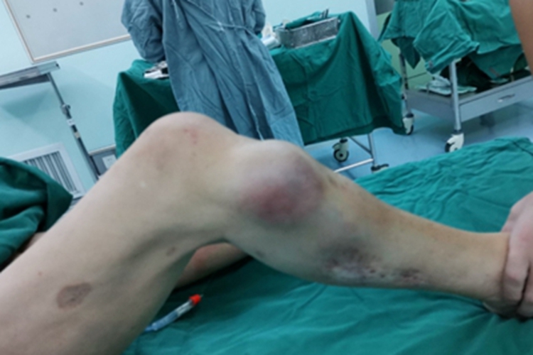 恶性纤维组织细胞瘤小腿症状图 恶性纤维组织细胞瘤小腿症状图