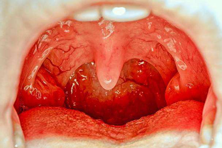 腭舌弓发红图片