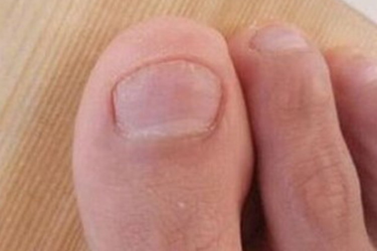 拔甲术后愈合图 拔甲术后愈合图