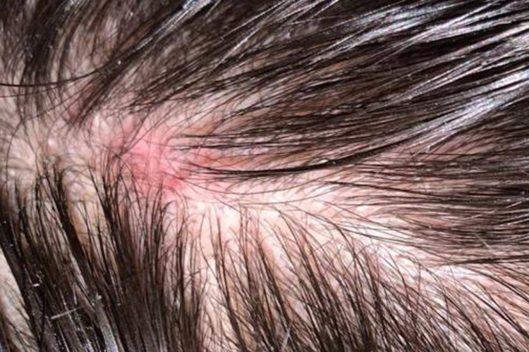 湿性型脂溢性皮炎图