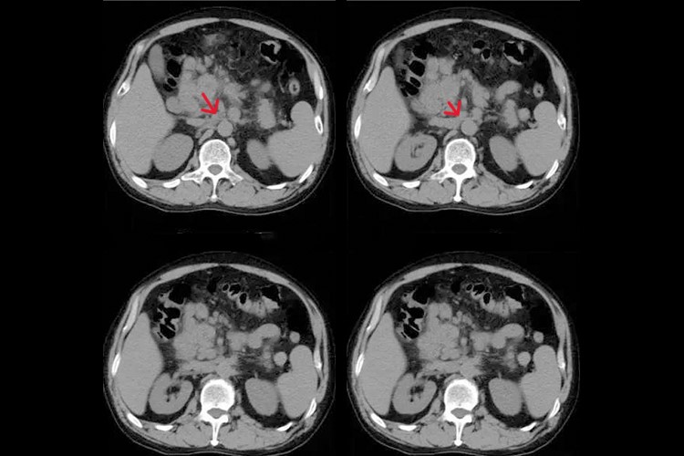 腹膜后淋巴结肿大影像图