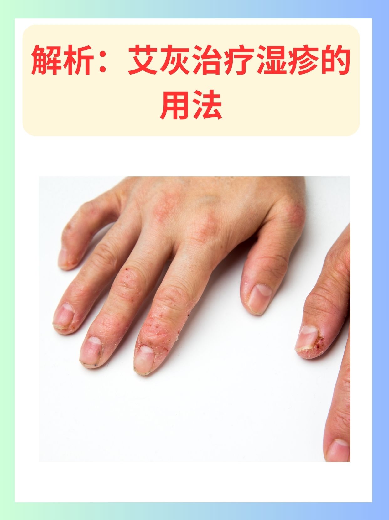 解析：艾灰治疗湿疹的用法