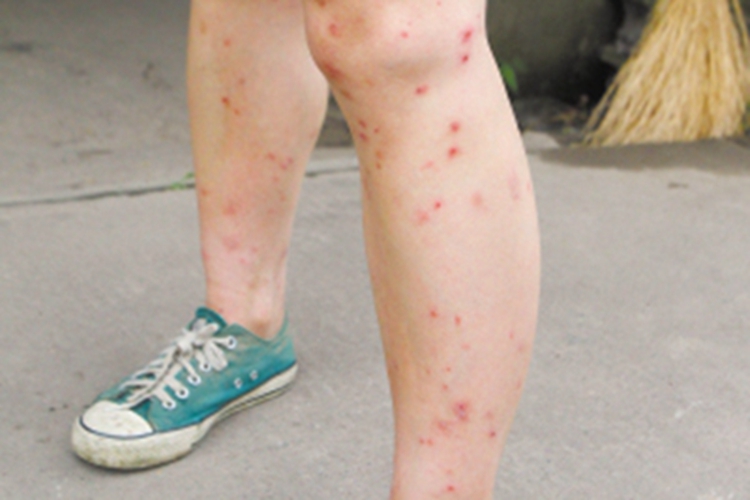 蚋叮咬引起的皮肤反应腿结痂图 蚋叮咬引起的皮肤反应腿结痂图