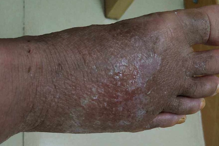 刺激性皮炎症状图