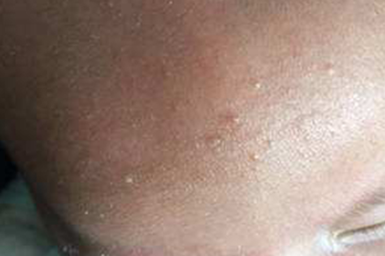 头皮深痱图 头皮深痱图