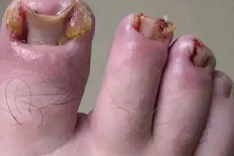 严重嵌甲图 严重嵌甲图