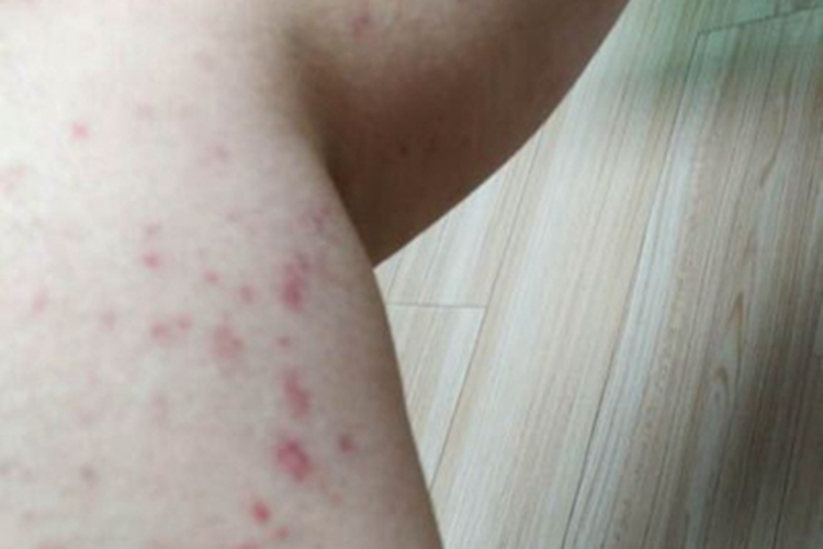 接触性荨麻疹大腿红点图