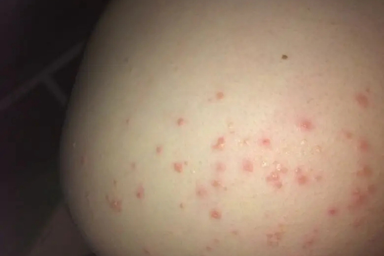 屁股长了痤疮图