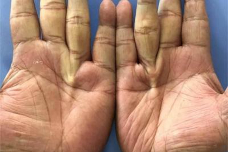 双手掌腱膜挛缩症图
