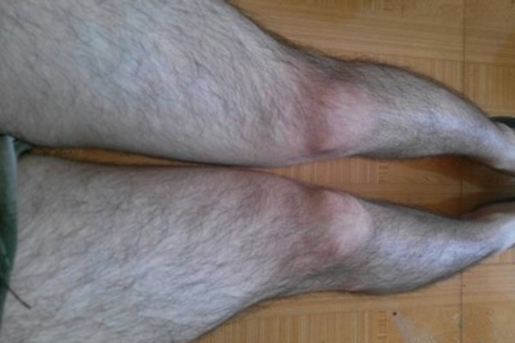 多毛症腿毛发过长图