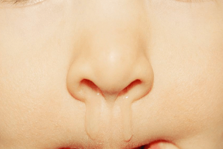 慢性鼻炎流清水样鼻涕图