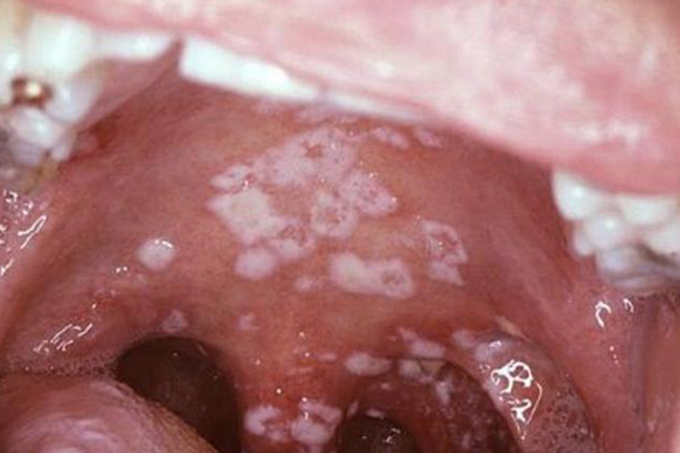 鹅口疮早期图 鹅口疮早期图