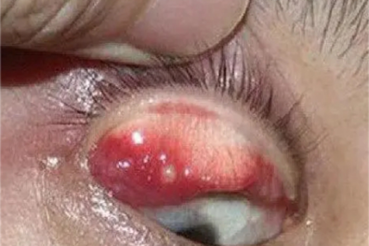 内睑腺炎眼睑红肿图 内睑腺炎眼睑红肿图