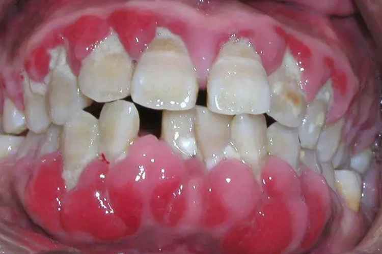 牙周炎图 牙周炎图