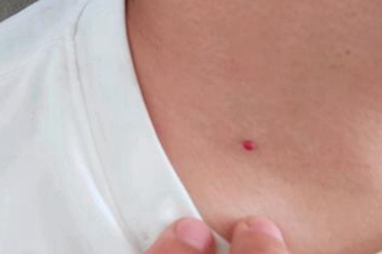 樱桃状血管瘤前颈症状图