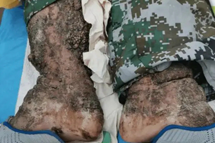 慢性期皮肤丝虫病症状图