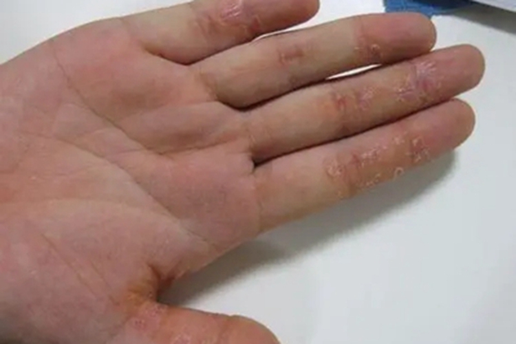 皲裂性湿疹手指干燥起皮图 皲裂性湿疹手指干燥起皮图